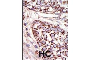 Formalin-fixed and paraffin-embedded human cancer tissue reacted with the primary antibody, which was peroxidase-conjugated to the secondary antibody, followed by DAB staining. (ERK1 antibody  (N-Term))