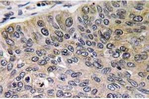 Immunohistochemistry (IHC) analyzes of Cathepsin E antibody in paraffin-embedded human lung carcinoma tissue. (Cathepsin E antibody)