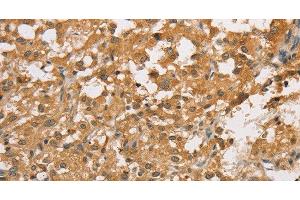 Immunohistochemistry of paraffin-embedded Human thyroid cancer using ARHGEF5 Polyclonal Antibody at dilution of 1:50 (ARHGEF5 antibody)