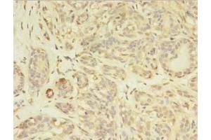 Immunohistochemistry of paraffin-embedded human breast cancer using ABIN7163630 at dilution of 1:100 (PDGFRB antibody  (AA 901-1106))