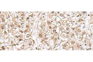 Immunohistochemistry of paraffin-embedded Human liver cancer tissue using RPL35 Polyclonal Antibody at dilution of 1:70(x200) (RPL35 antibody)