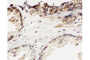 Anti-Kallikrein 11 antibody, IHC(P) IHC(P): Human Prostatic Cancer Tissue
