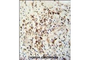 HAUS5 Antibody (N-term) (ABIN651423 and ABIN2840230) immunohistochemistry analysis in formalin fixed and paraffin embedded human colon carcinoma followed by peroxidase conjugation of the secondary antibody and DAB staining.