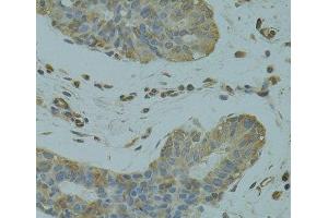 Immunohistochemistry of paraffin-embedded Human breast cancer using DGKQ Polyclonal Antibody at dilution of 1:100 (40x lens). (DGKQ antibody)