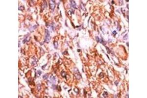 IHC analysis of FFPE human hepatocarcinoma tissue stained with the p-Rb1 antibody.