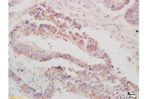 Formalin-fixed and paraffin embedded human colon carcinoma labeled with Anti-ATF3 Polyclonal Antibody, Unconjugated (ABIN669561) at 1:200 followed by conjugation to the secondary antibody and DAB staining (ATF3 antibody  (AA 51-150))