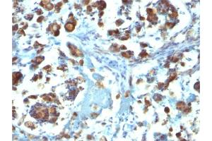 Formalin-fixed, paraffin-embedded human Gastric Carcinoma stained with MUC3 Mouse Monoclonal Antibody (M3. (MUC3A antibody)