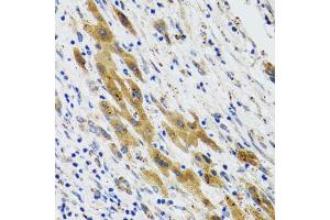 Immunohistochemistry of paraffin-embedded human liver cancer using PLA2G2D antibody (ABIN5974036) at dilution of 1/100 (40x lens).