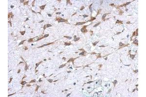 IHC-P Image Immunohistochemical analysis of paraffin-embedded human hepatoma, using UGT1A, antibody at 1:500 dilution.