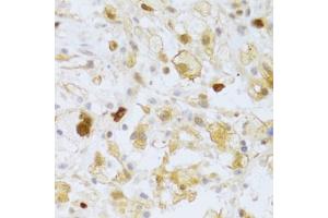 Immunohistochemistry of paraffin-embedded human brain astrocytoma using FCN1 Antibody (ABIN2562567) at dilution of 1:100 (40x lens). (FCN1 antibody)