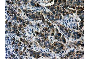 Immunohistochemical staining of paraffin-embedded Carcinoma of Human lung tissue using anti-LGALS3BP mouse monoclonal antibody. (LGALS3BP antibody  (AA 19-300))