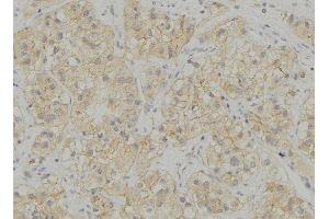 ABIN6272934 at 1/100 staining Human breast cancer tissue by IHC-P. (STING/TMEM173 antibody  (Internal Region))