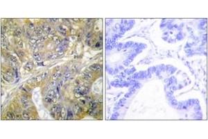 Immunohistochemistry analysis of paraffin-embedded human colon carcinoma tissue, using EPS8L3 Antibody. (EPS8-Like 3 antibody  (AA 401-450))
