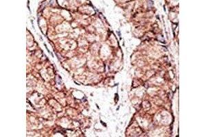 IHC analysis of FFPE human breast carcinoma tissue stained with the TLR5 antibody (TLR5 antibody  (AA 71-102))