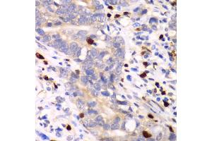 Immunohistochemistry of paraffin-embedded human gastric cancer using S100A12 antibody (ABIN6291358) at dilution of 1:100 (40x lens). (S100A12 antibody)