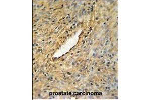 CEP63 Antibody (Center) (ABIN651000 and ABIN2840033) IHC analysis in formalin fixed and paraffin embedded prostate carcinoma followed by peroxidase conjugation of the secondary antibody and DAB staining. (CEP63 antibody  (AA 520-548))