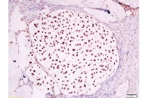 Formalin-fixed and paraffin embedded human cervical carcinoma labeled with Anti-GCMA Polyclonal Antibody, Unconjugated  at 1:200 followed by conjugation to the secondary antibody and DAB staining. (GCM1 antibody  (AA 121-220))