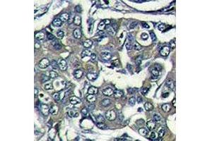 IHC analysis of formalin fixed paraffin embedded human breast carcinoma stained with EIF4E2 antibody (EIF4E2 antibody  (AA 12-41))