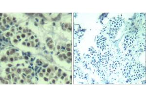 Immunohistochemical analysis of paraffin-embedded human breast carcinoma tissue using MDM2 (Ab-166) Antibody (E021550). (MDM2 antibody)