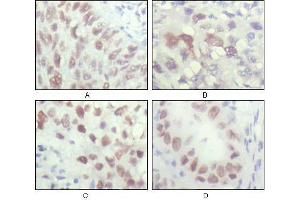 Immunohistochemical analysis of paraffin-embedded human lung carcinoma (A), liver carcinoma (B), breast carcinoma (C) and kiney carcinoma (D), showing nuclear localization with DAB staining using CHK2 antibody. (CHEK2 antibody  (AA 481-531))
