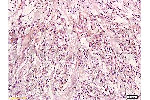 Formalin-fixed and paraffin embedded: human endometrium tissue labeled with Anti-KRAS Polyclonal Antibody (ABIN736671), Unconjugated at 1:200, followed by conjugation to the secondary antibody and DAB staining (K-RAS antibody  (AA 25-130))