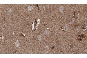 ABIN6279767 at 1/100 staining Human brain cancer tissue by IHC-P. (ARHGAP20 antibody  (Internal Region))