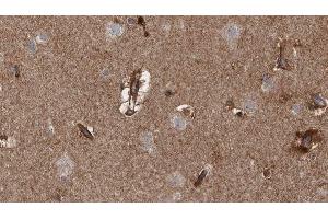 ABIN6279767 at 1/100 staining Human brain cancer tissue by IHC-P.