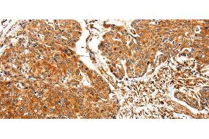 Immunohistochemistry of paraffin-embedded Human esophagus cancer using TPM2 Polyclonal Antibody at dilution of 1:30 (TPM2 antibody)