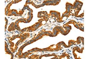 The image on the left is immunohistochemistry of paraffin-embedded Human thyroid cancer tissue using ABIN7192030(PRSS50 Antibody) at dilution 1/30, on the right is treated with synthetic peptide. (MASP1 antibody)