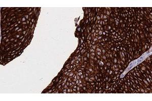 ABIN6268889 at 1/100 staining Human urothelial cancer tissue by IHC-P. (FAS antibody  (C-Term))