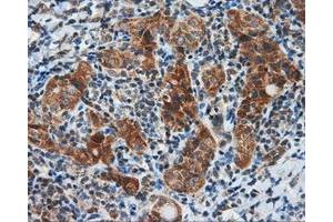 Immunohistochemical staining of paraffin-embedded Carcinoma of liver tissue using anti-SIL1 mouse monoclonal antibody.