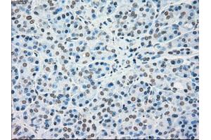 Immunohistochemical staining of paraffin-embedded Carcinoma of kidney tissue using anti-MAP2K4mouse monoclonal antibody. (MAP2K4 antibody)