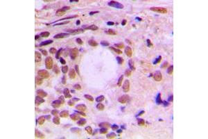 Immunohistochemical analysis of Cyclin F staining in human breast cancer formalin fixed paraffin embedded tissue section. (Cyclin F antibody  (C-Term))