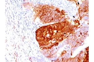 Formalin-fixed, paraffin-embedded human Colon Carcinoma stained with ALDH1A1 Mouse Monoclonal Antibody (ALDH1A1/1381). (ALDH1A1 antibody  (AA 315-434))