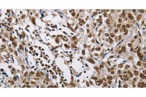 Immunohistochemistry of paraffin-embedded Human esophagus cancer tissue using CMTM2 Polyclonal Antibody at dilution 1:60 (CMTM2 antibody)