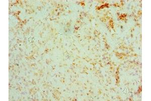 Immunohistochemistry of paraffin-embedded human ovarian cancer using ABIN7158679 at dilution of 1:100 (BRCC3 antibody  (AA 14-316))