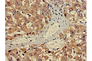 Immunohistochemistry of paraffin-embedded human liver cancer using ABIN7142600 at dilution of 1:100 (ALAS1 antibody  (AA 57-285))