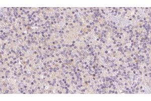 ABIN6273120 at 1/100 staining Human lymph cancer tissue by IHC-P. (HBXIP antibody  (Internal Region))