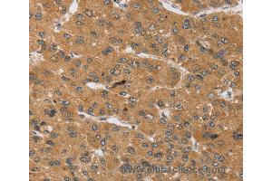 Immunohistochemistry of Human cervical cancer using KCNJ15 Polyclonal Antibody at dilution of 1:40 (KCNJ15 antibody)