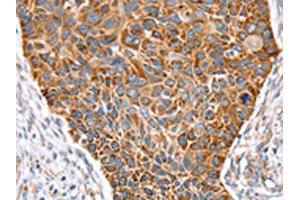 The image on the left is immunohistochemistry of paraffin-embedded Human esophagus cancer tissue using ABIN7131122(SNX11 Antibody) at dilution 1/30, on the right is treated with fusion protein. (SNX11 antibody)