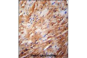 TFB2M Antibody immunohistochemistry analysis in formalin fixed and paraffin embedded human heart carcinoma followed by peroxidase conjugation of the secondary antibody and DAB staining.