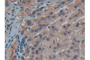 Detection of CD55 in Human Liver cancer Tissue using Polyclonal Antibody to Cluster Of Differentiation 55 (CD55) (CD55 antibody  (AA 35-285))