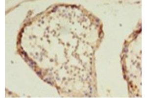 Immunohistochemistry of paraffin-embedded human colon cancer using ABIN7155301 at dilution of 1: 100 (HDAC1 antibody  (AA 1-482))