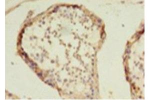 Immunohistochemistry of paraffin-embedded human colon cancer using ABIN7155301 at dilution of 1: 100 (HDAC1 antibody  (AA 1-482))