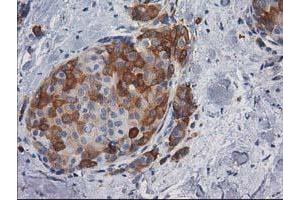 Immunohistochemical staining of paraffin-embedded Adenocarcinoma of Human breast tissue using anti-AK5 mouse monoclonal antibody.