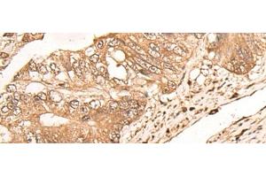 Immunohistochemistry of paraffin-embedded Human colorectal cancer tissue using MAGEA1 Polyclonal Antibody at dilution of 1:65(x200) (MAGEA1 antibody)