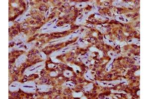 IHC image of ABIN7162965 diluted at 1:200 and staining in paraffin-embedded human liver cancer performed on a Leica BondTM system. (PEX11A antibody  (AA 106-219))