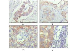 Immunohistochemical analysis of paraffin-embedded human ovary carcinoma (A), kidney carcinoma (B), lung carcinoma (C) and breast carcinoma (D), showing cytoplasmic and membrane localization with DAB staining using ALCAM mouse mAb. (CD166 antibody)