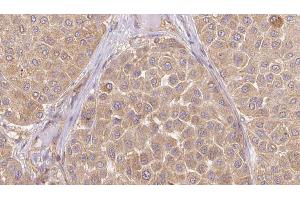 ABIN6273647 at 1/100 staining Human Melanoma tissue by IHC-P. (IGFL1 antibody)