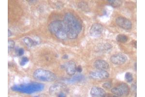 Immunohistochemistry (IHC) image for anti-Interleukin 6 (IL6) antibody (Biotin) (ABIN2475036) (IL-6 antibody  (Biotin))
